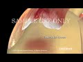 www.nucleusinc.com Esta animación médica en 3D describe cómo se puede reparar un manguito rotador desgarrado con técnicas artroscópicas. Las fibras del tendón desgarrado se reparan con suturas y el tendón se vuelve a unir al húmero con anclas de sutura. Éste es un procedimiento mínimamente invasivo que involucra un artroscopio y pequeñas herramientas quirúrgicas.