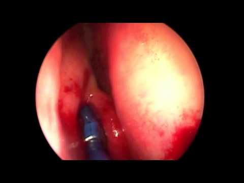 how to drain frontal sinus