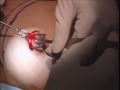 ipsc on discovery channels cosmetic surgery