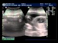 Usg de  30 semanas do Ant�nio