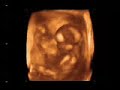 Embrion de 13 semanas