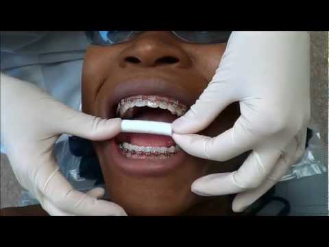 how to whiten braces elastics