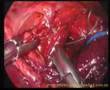 Laparoscopic fundoplication