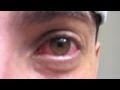 PUNCHED IN THE EYE!