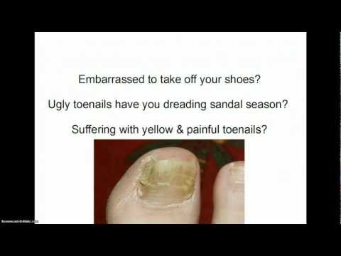 how to kill toenail fungus with bleach