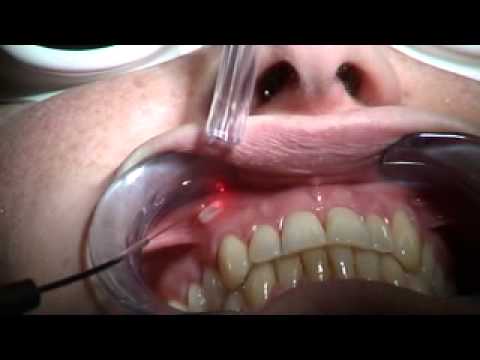 how to treat aftas