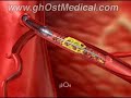 Cardiology Medical Animation Reel Cardiology Medical Animation Reel