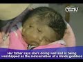 TnnTV World News_two_faced_baby