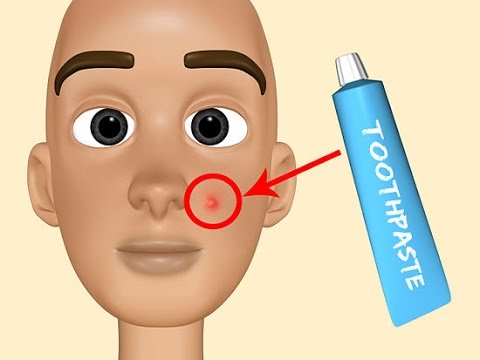 how to do the toothpaste trick for acne