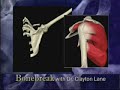Shoulder Impingement Shoulder Impingement
