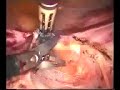 hysterectomie coelioscopique sur pelvis adherentiel