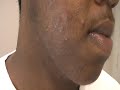 The Acne Practice (African American 3) The Acne Practice (African American 3)