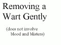 wart Remove without pain - only apple cider vinegar