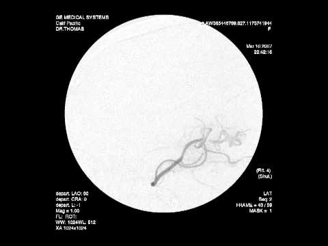 micro catheter - The blood clot can be seen dissolving, in motion through the artery.
