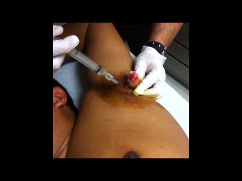 how to relieve underarm cyst pain