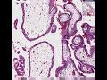 Histopathology Fallopian tube--Ectopic pregnancy with embryo Histopathology Fallopian tube--Ectopic pregnancy with embryo