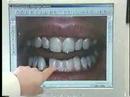 Porcelain Veneers by Kourosh Maddahi - Beverly Hills Dentist