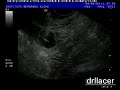 Egg retrieval (IVF IMAGES)