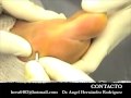 JUANETES HALLUX VALGUS  CIRUGIA MINIMA INVASIVA DE PIE JUANETES