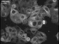 Breast cancer cells dividing