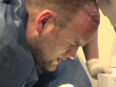 how to hide hair transplant at work