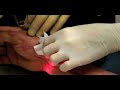UltraPulse Deep Fx Burn Treatment by Dr.Escobedo