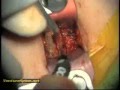 Anterior Cervical Discectomy and Fusion (ACDF) - Brian D. Rudin, M.D.