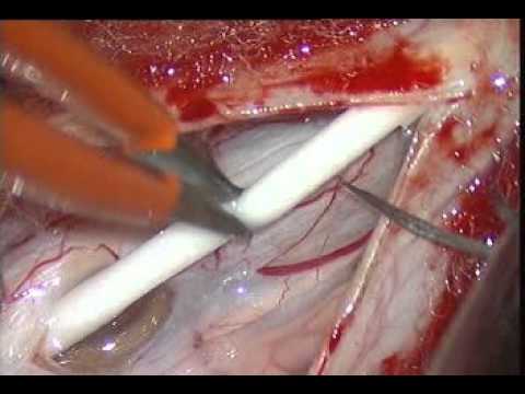 how to treat syringomyelia