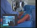 Laserchirurgie varices spataders