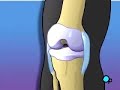 PreOp® Patient Education Arthroscopic Meniscus Repair, Knee