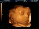 3D Ultrasound of Jacob - 2
