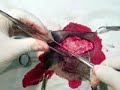 Ablaci�n de un tumor d epiel en perro