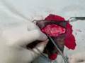 Ablación de un tumor d epiel en perro