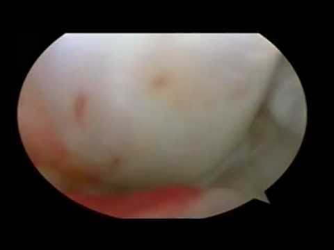 how to cure osteophytes