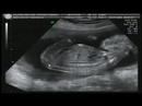 4º Ultrasson da Madalena o Morfologica