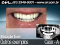 Protocolo inferior é o nome dado a técnica que substitui todos dentes na arcada inferior através de implantes dentários. O implante dental é um pequeno cilindro confeccionado em titânio puro, com roscas externas semelhante a um parafuso. O titânio adere ao tecido ósseo, produzindo uma ligação biológica entre o osso eo titânio, conhecida como osseointegração.