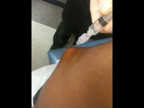 how to drain bursitis