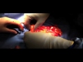 Splenic Flexure Carcinoma- Laparoscopic Resection Splenic Flexure Carcinoma- Laparoscopic Resection