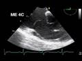 videos de TEE severe TR with prolapse