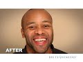 Teeth Whitening and Teeth Alignment Procedure Testimonial