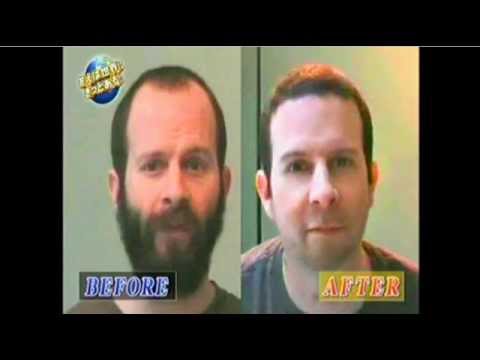 how to do hair transplant yourself