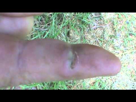 how to treat wound infection