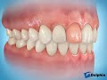 Tooth Implant (Anterior)