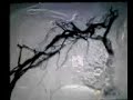 blood clot