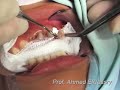 Fiber Core Post Technique, Clinical Pediatric Dentistry Fiber Core Post Technique, Clinical Pediatric Dentistry