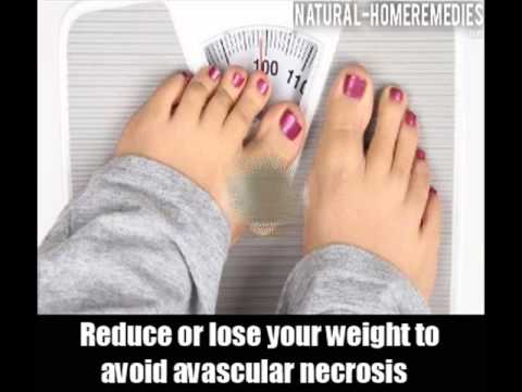 how to cure avascular necrosis