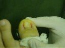 The Removal of an Ingrown ToeNail