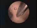 HISTEROSCOPIA SIMULADOR