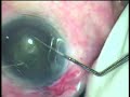 phacoemulsification divide & conquer