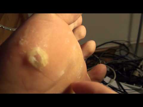 how to remove callus